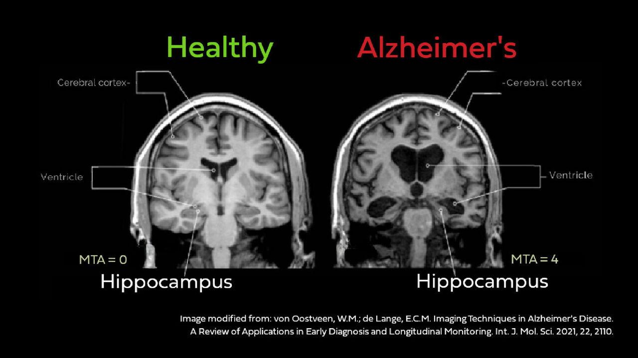 Can frequent navigation protect against Alzheimer's? New study offers clues