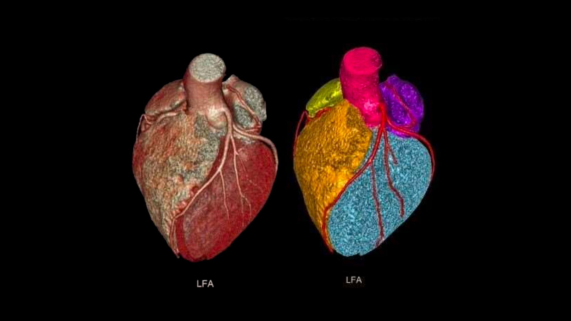 Stronger chest and back muscles may lower heart attack risk -- AI analysis of 50000 patients finds